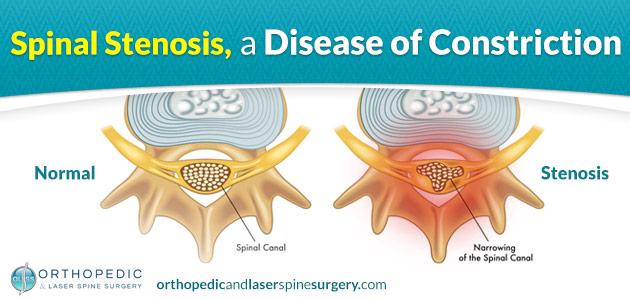 Spinal Stenosis, a Disease of Constriction & Compression