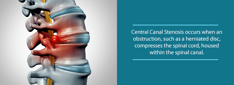 central canal stenosis from herniated disc