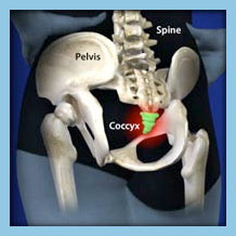 Tailbone Pain Treatment For Coccydynia In Malaysia