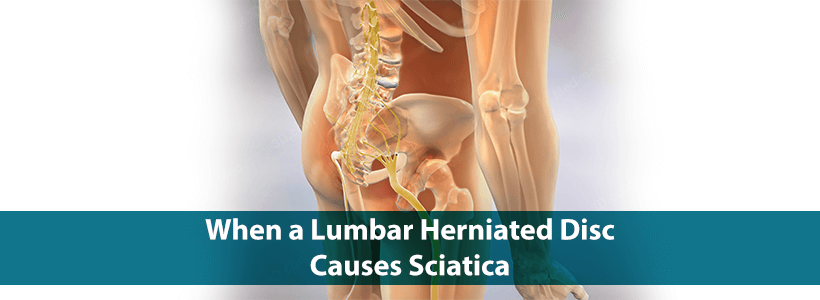 When a Lumbar Herniated Disc Causes Sciatica